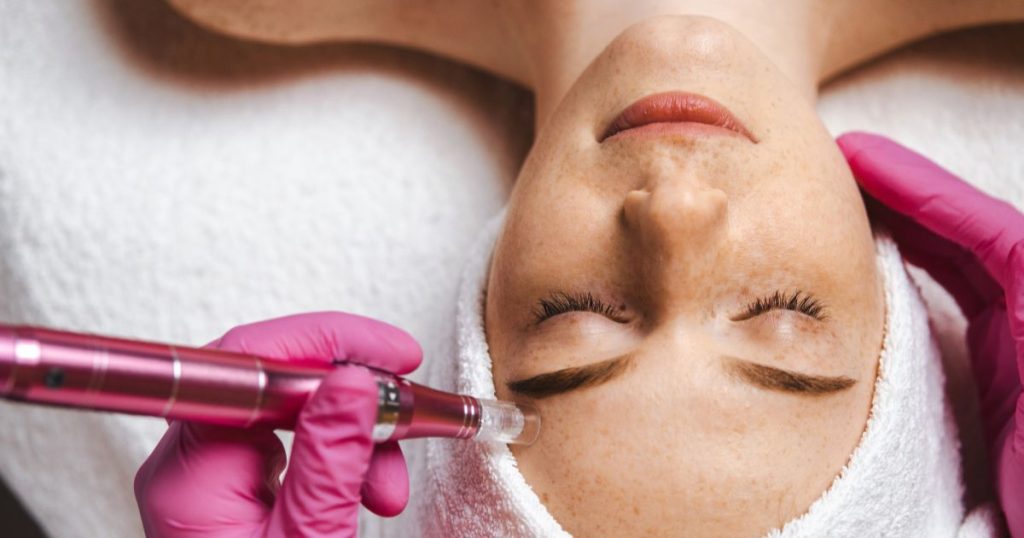 microneedling treatment near me newport beach, ca